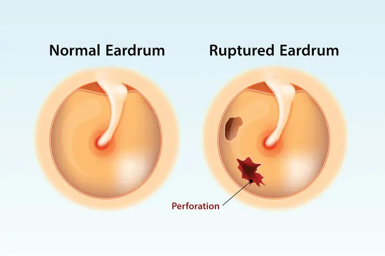Eardrum rupture treatment in Jayanagar