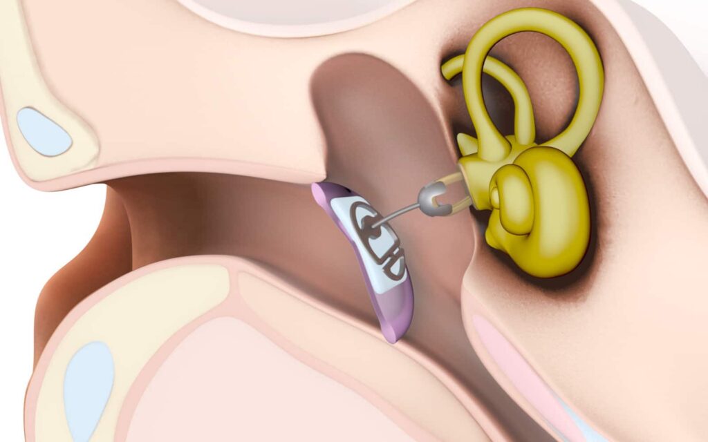Ossiculoplasty in Banashankari