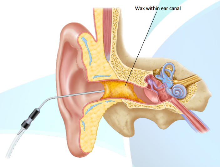 Ear Micro Surgery in BTM Layout