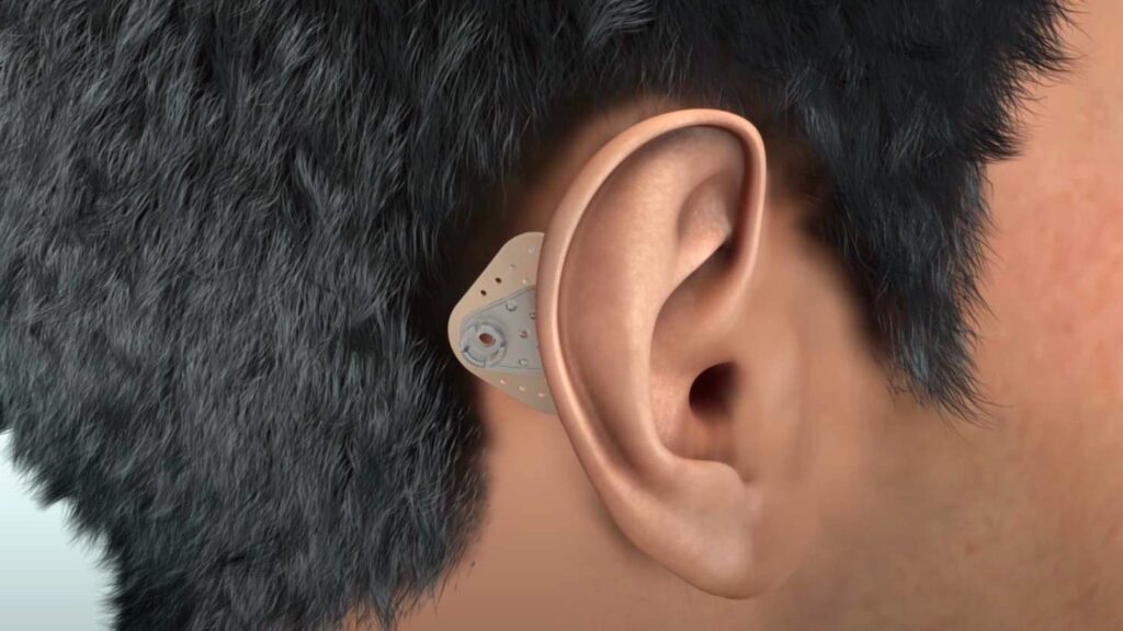 Adhear hearing system in Bangalore