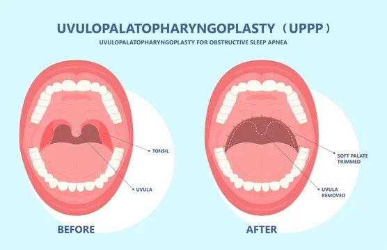 Uvulopalatopharyngoplasty in Bangalore