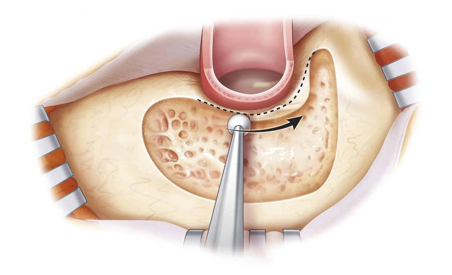 Mastoidectomy in Bangalore