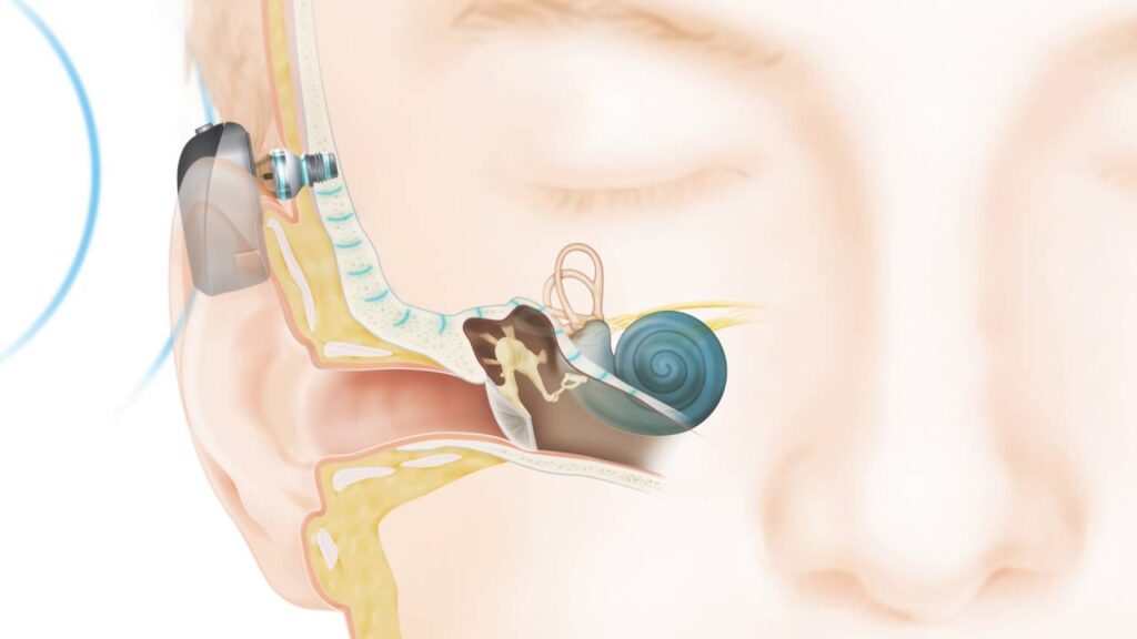 Bone conduction hearing implant surgery in Kanakapura Road