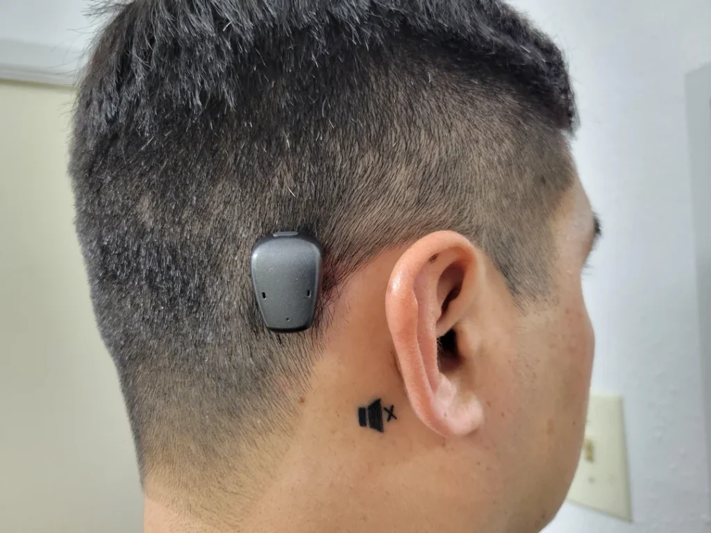 Bone conduction implant in Bangalore