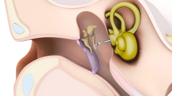 Middle ear implant surgery in BTM Layout